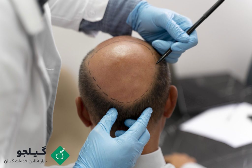 چرا رشت برای کاشت مو انتخاب مناسبی است؟